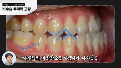 비수술 주걱턱 교정 결과 관련 이미지 3