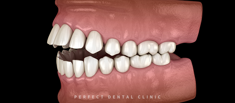 개방교합 치아교정 결과는? 관련 이미지 2