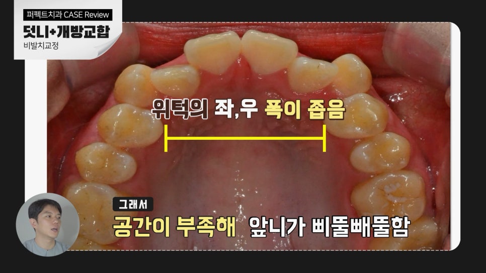 덧니+개방교합, MARPE를 이용한 비발치교정 관련 이미지 5
