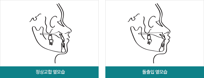 돌출입교정 후기 및 비용은? 관련 이미지 1