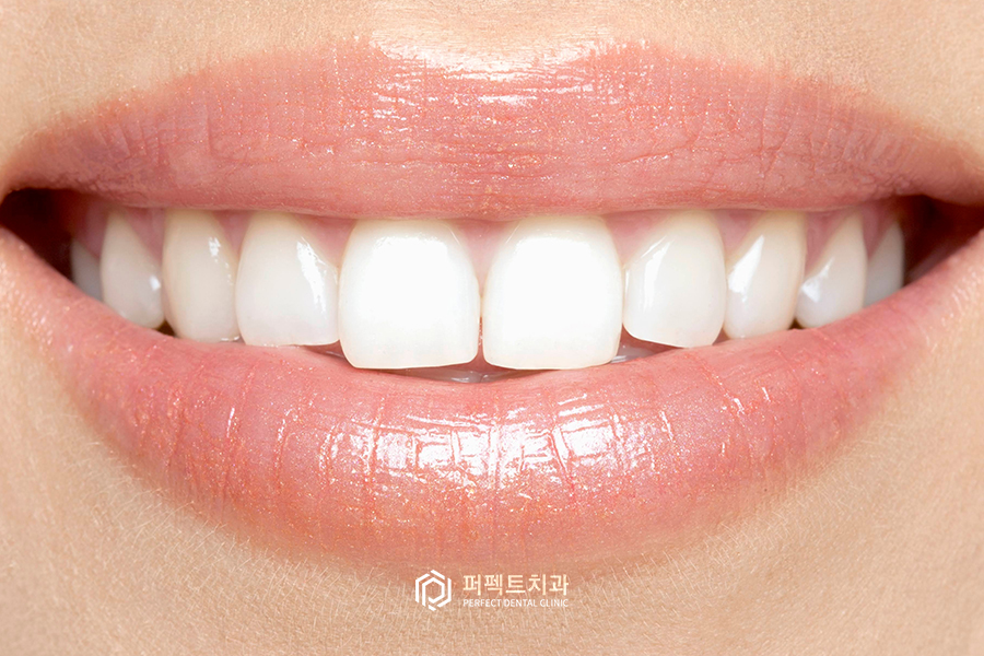 직접 받아본✨치아미백 과정② 관련 이미지 2