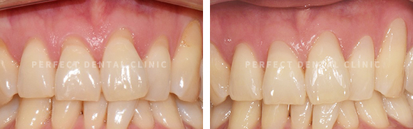 강남 충치치료비용 알고가자! 관련 이미지 4