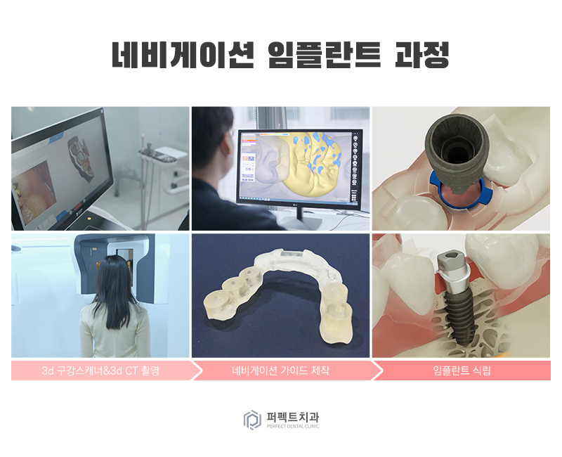 네비게이션 임플란트란? 관련 이미지 4