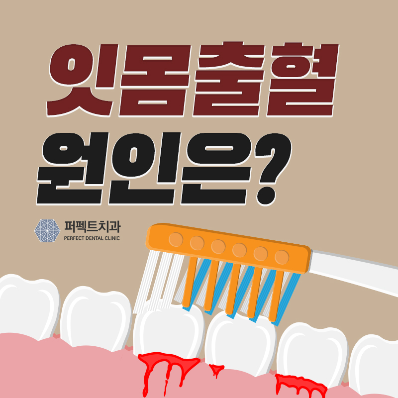 잇몸 출혈 원인 알아보자! 관련 이미지 1