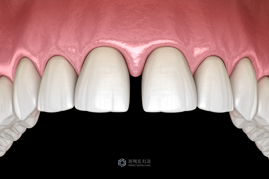 보철치료 후 치아가 벌어지는 이유는? 관련 이미지 2