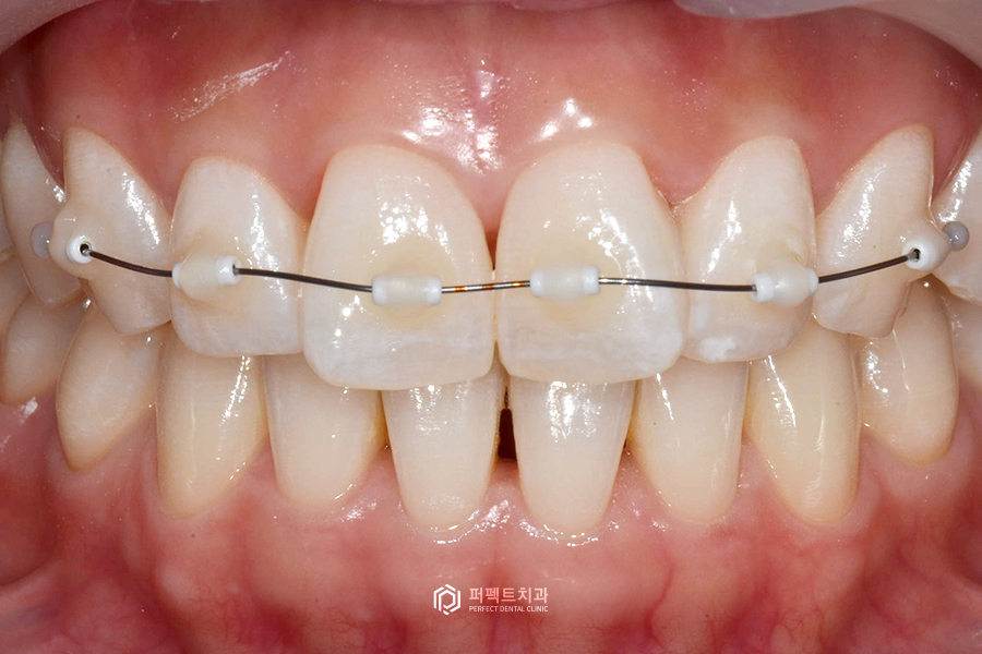 나비치아, 부분교정vs라미네이트 치과의사가 추천하는 방법은? 관련 이미지 4