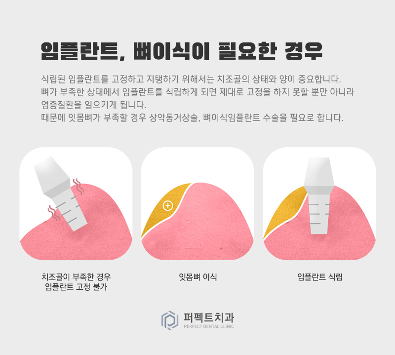 컴퓨터 분석을 통한 임플란트 관련 이미지 9
