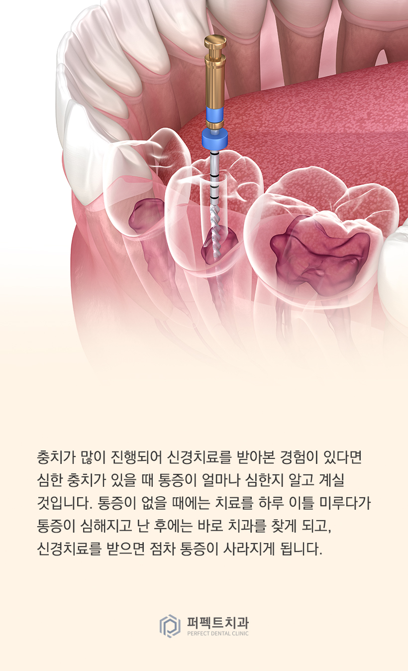 신경치료 후 크라운이 꼭 필요한 이유는? 관련 이미지 1