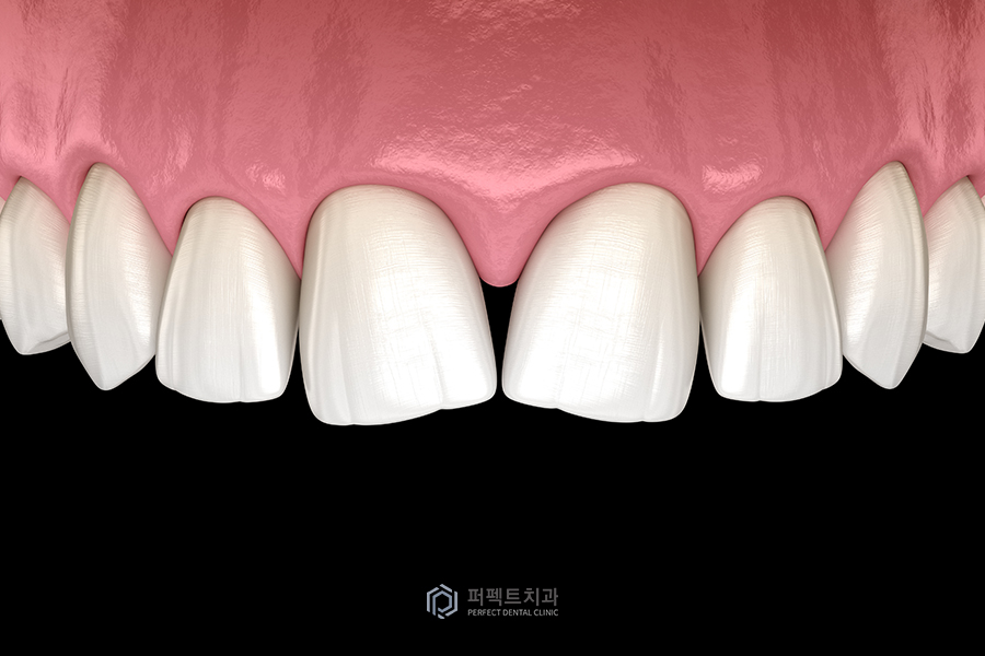 앞니 레진치료의 장단점은? 관련 이미지 5