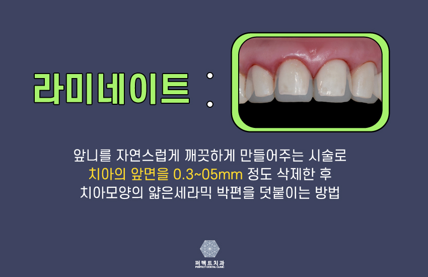 연예인 라미네이트 나도 할래!! 관련 이미지 4