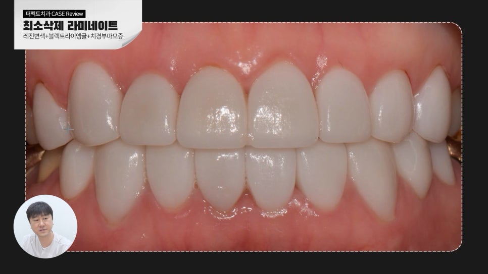 변색된 레진👉라미네이트 교체 관련 이미지 4