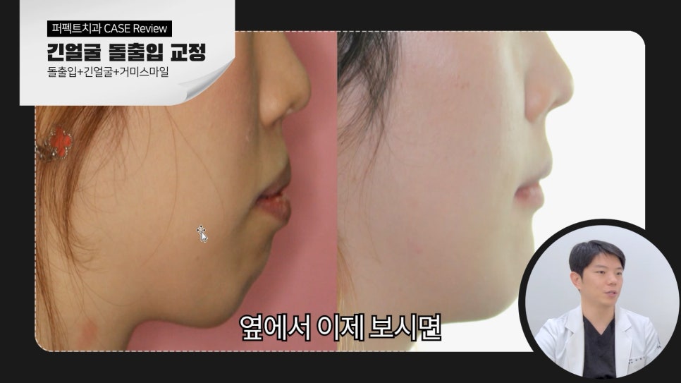 긴얼굴+돌출입+거미스마일 비수술교정case 관련 이미지 2