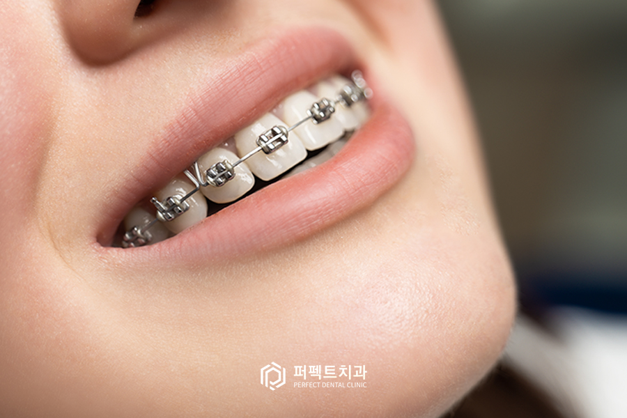 치아교정 시 치간삭제는 무조건 나쁘다? 관련 이미지 1
