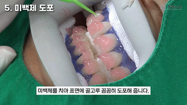 직접 받아본✨치아미백 과정① 관련 이미지 6