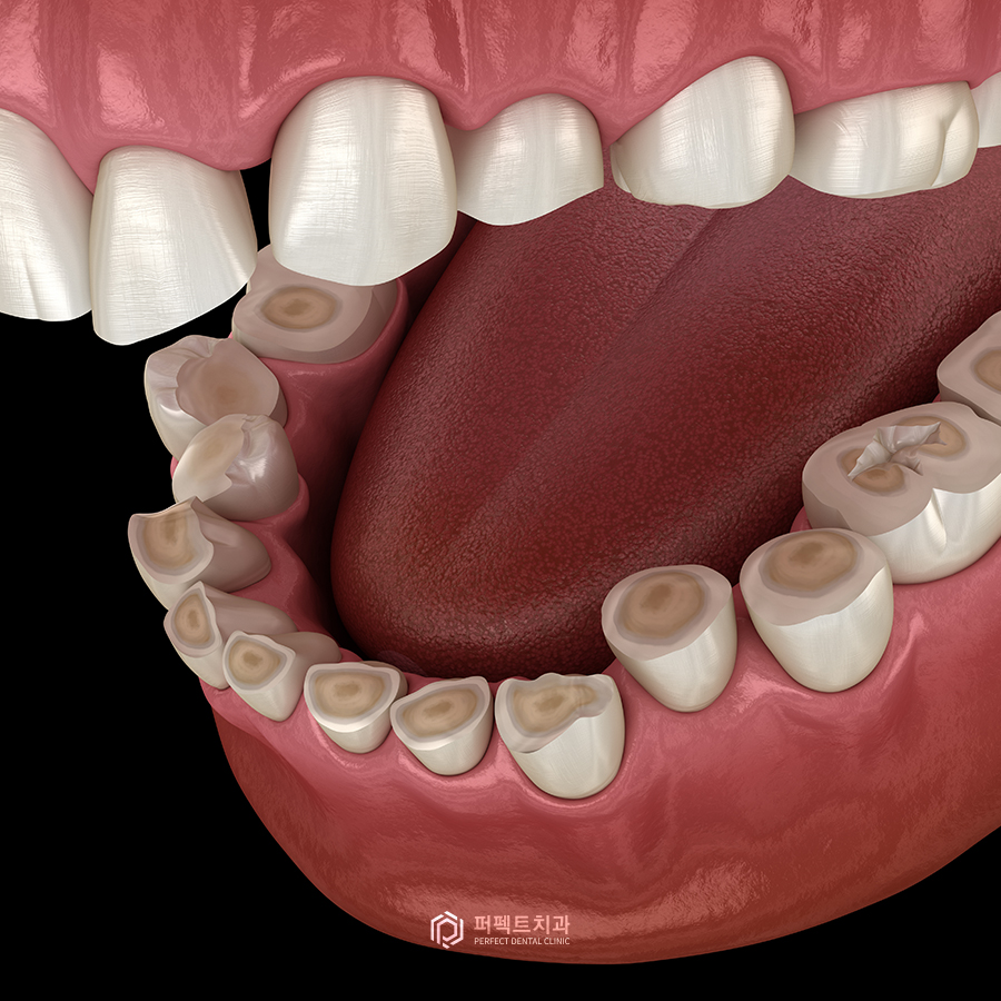 치아도 부식이 된다? 부식의 원인과 치료방법! 관련 이미지 2