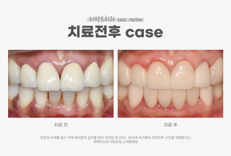PFM크라운&rarr;라미네이트, 크라운 교체 케이스 관련 이미지 8