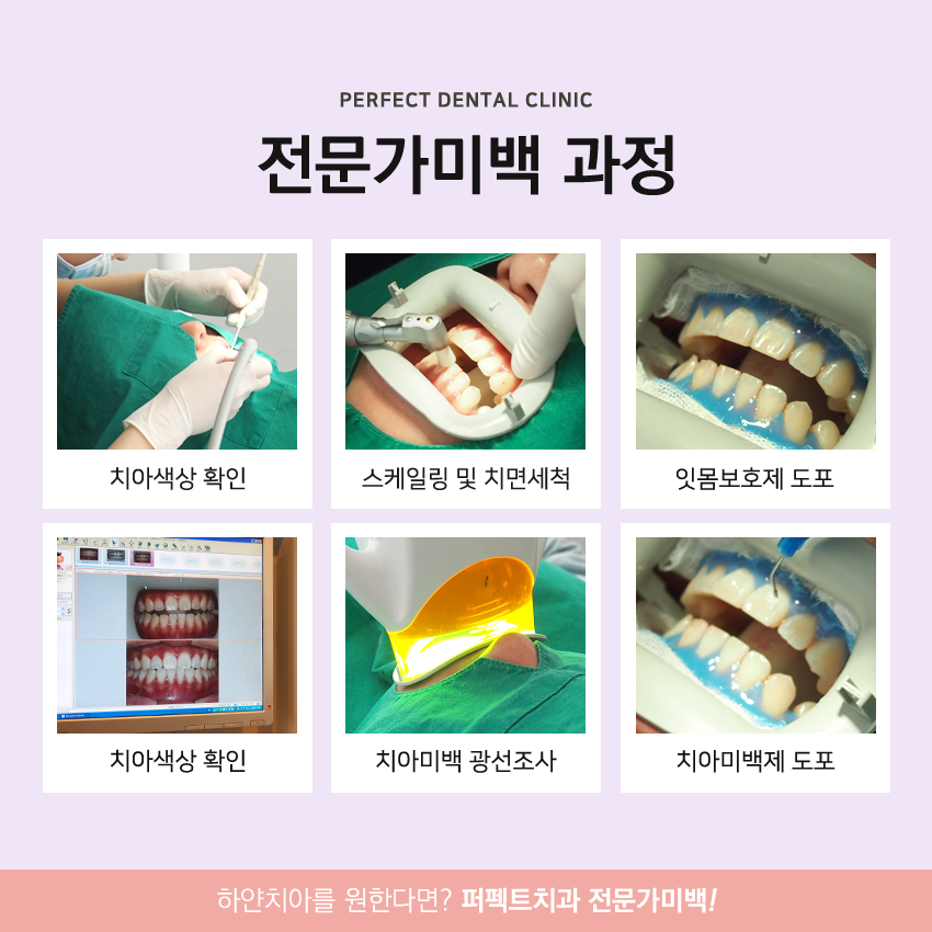 누런이 치아미백으로 탈출하자! 관련 이미지 5