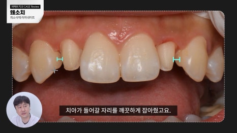 주변 치아보다 작은 관련 이미지 6
