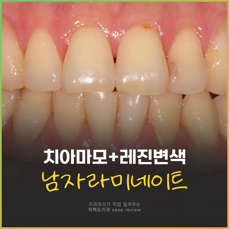 남자 라미네이트, 얼마나 밝게 가능할까? 관련 이미지 1