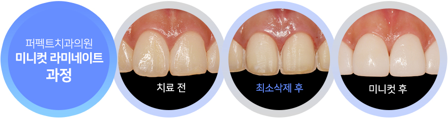 라미네이트 치료 시 참고사항은? 관련 이미지 5