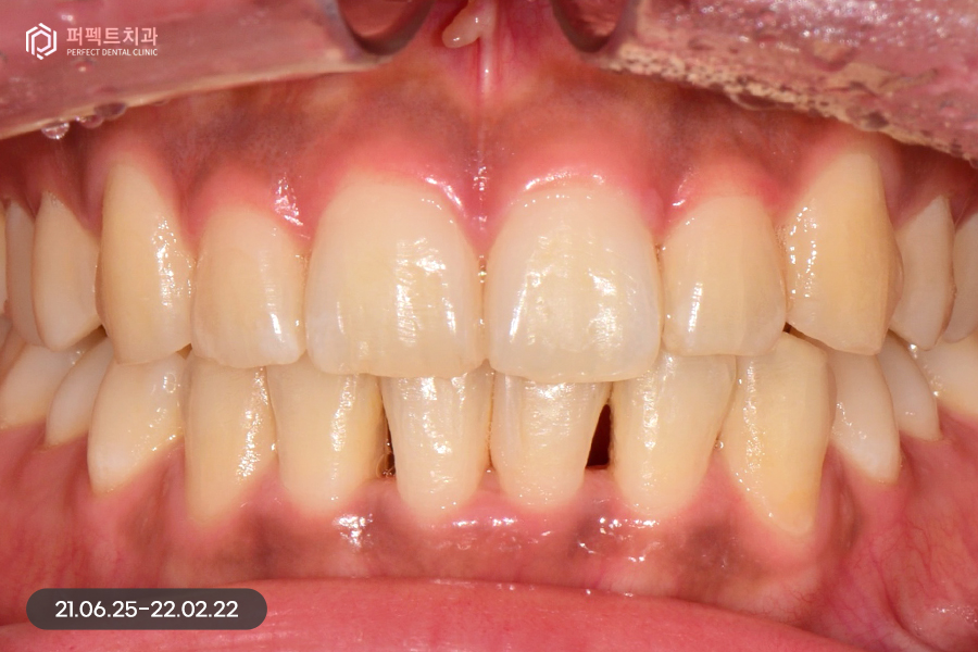 삐뚠 치아도 최소삭제가 가능하게👌🏻 교정 후 폴리네이트 관련 이미지 5