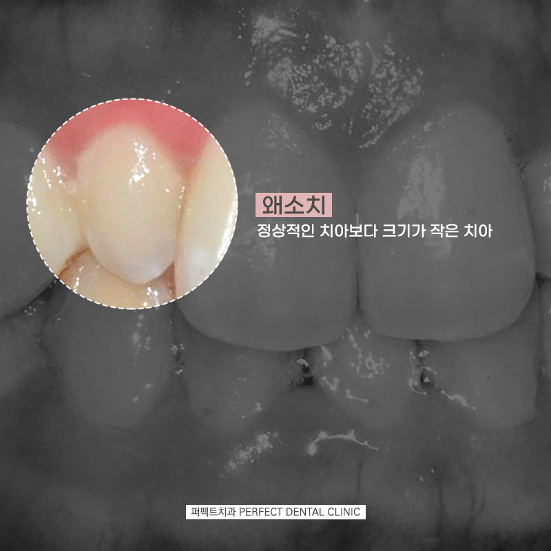 왜소치(작은치아)는 무삭제로 라미네이트 가능한가요? 관련 이미지 2