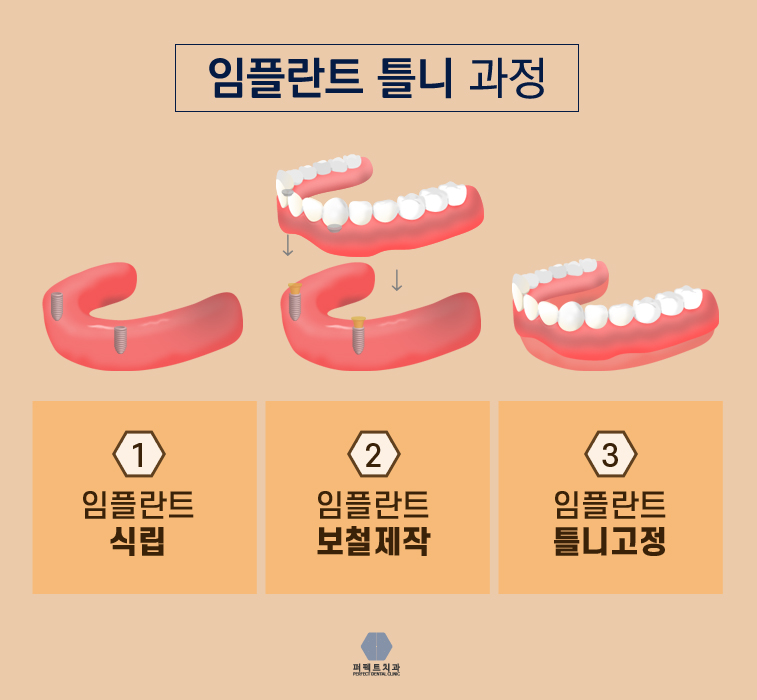 전체임플란트 고민되는데.. 관련 이미지 5