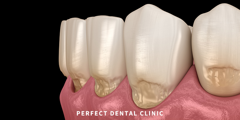 시린 이 치경부 마모증 비용 관련 이미지 3