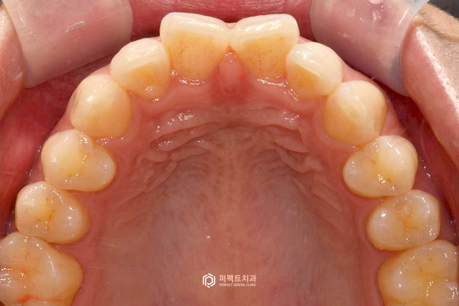나비치아, 부분교정vs라미네이트 치과의사가 추천하는 방법은? 관련 이미지 3