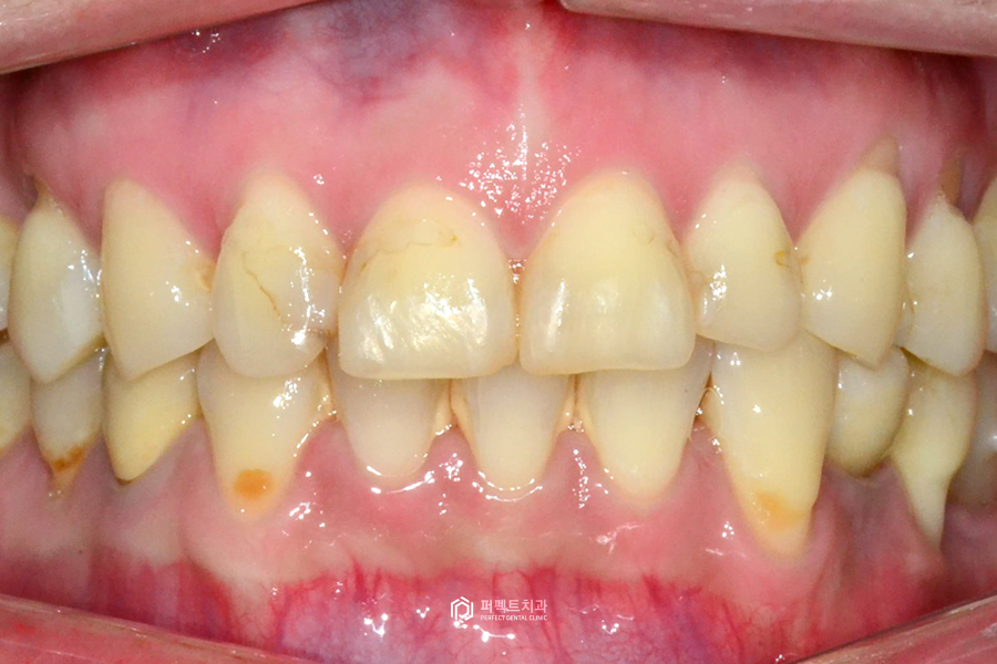레진으로 변색+마모된 치아, 개선 방법은? 관련 이미지 5