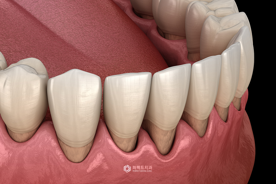 치료해도 자꾸 벌어지는 치아..😨 원인은? 관련 이미지 8
