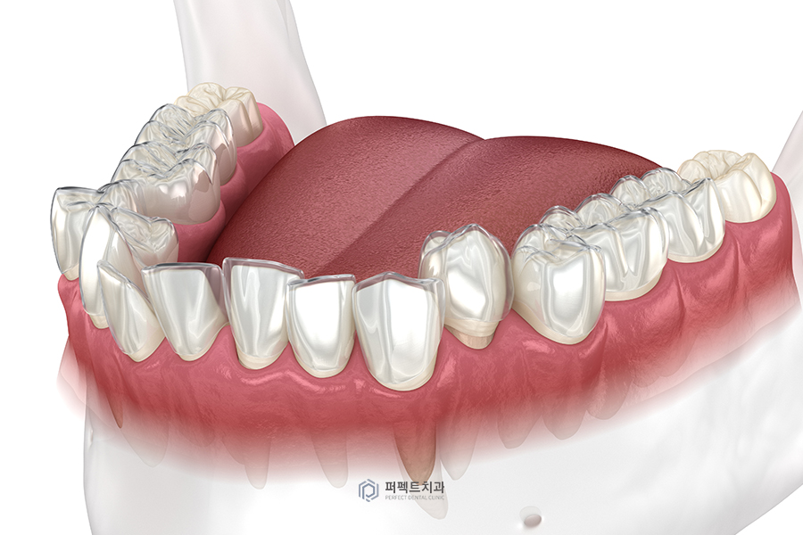 투명교정|인비절라인 Package 알아보기① 관련 이미지 4