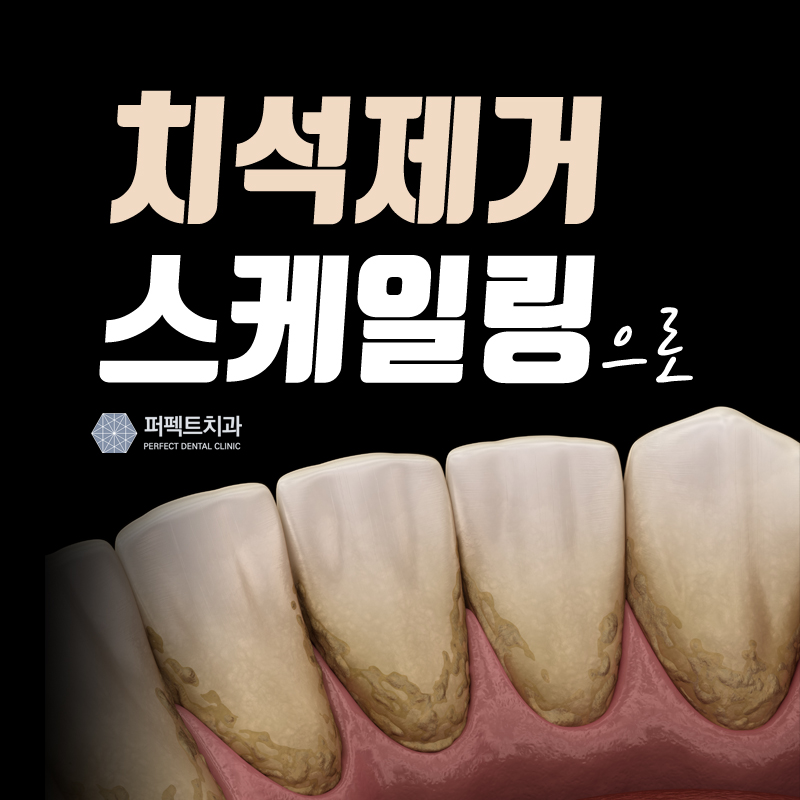 치석 제거는 스케일링으로! 관련 이미지 1