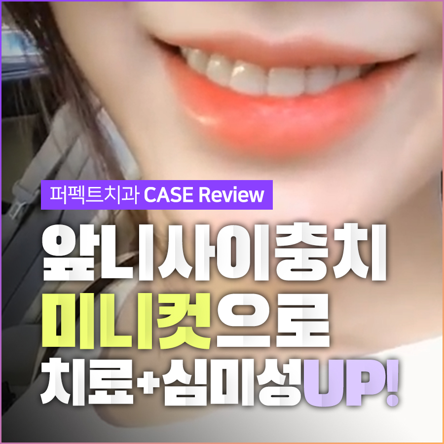 앞니충치? 최소삭제라미네이트or폴리네이트로 치료! 관련 이미지 1