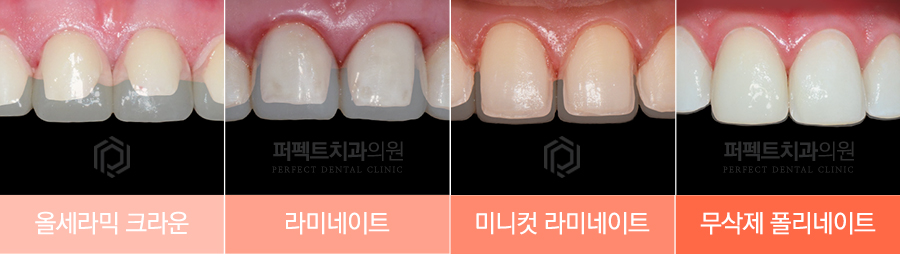 라미네이트 치료 시 참고사항은? 관련 이미지 3