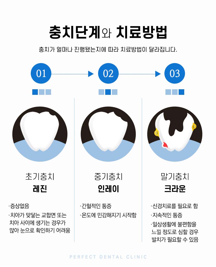 강남치과 충치 인레이 비용 관련 이미지 4