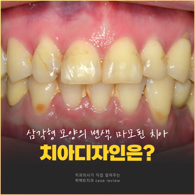 레진으로 변색+마모된 치아, 개선 방법은? 관련 이미지 1