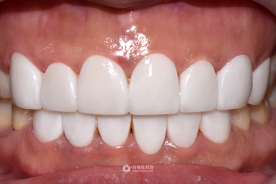 라미네이트 디자인👄｜치과의사가 고른 것vs환자가 고른 것, 어떤 걸로? 관련 이미지 10