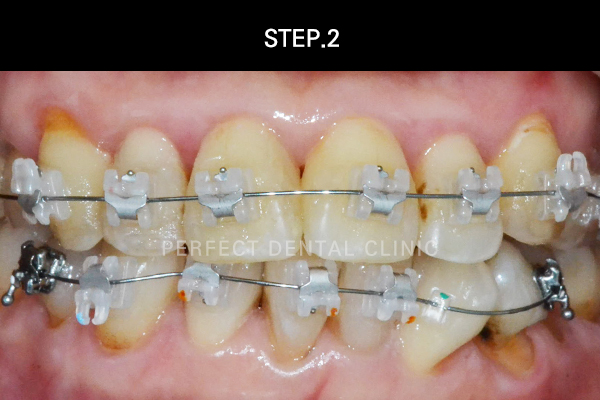 연예인라미네이트후기 관련 이미지 3