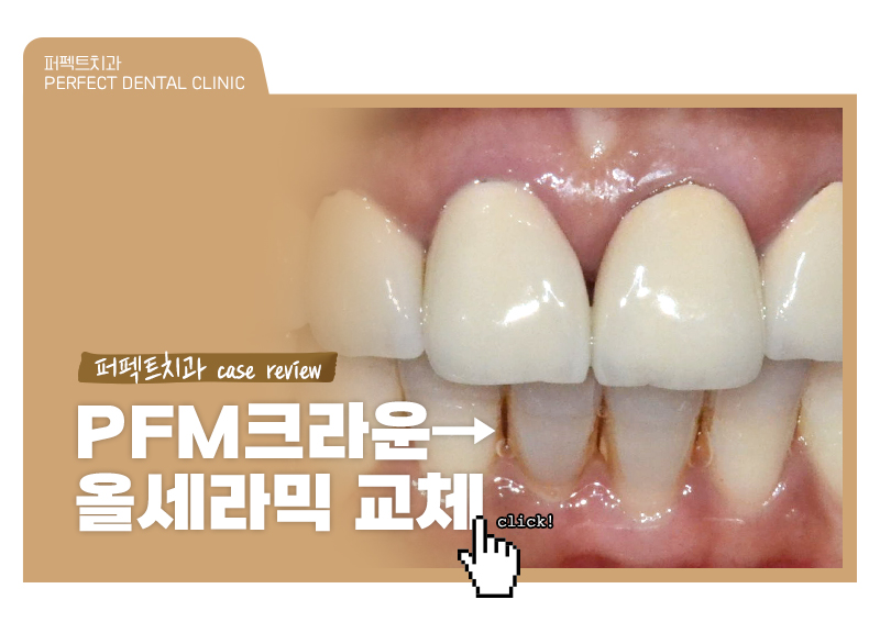 PFM크라운&rarr;라미네이트, 크라운 교체 케이스 관련 이미지 1