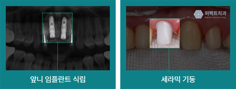 임플란트 시 가장 많이 하는 질문 Best 관련 이미지 3