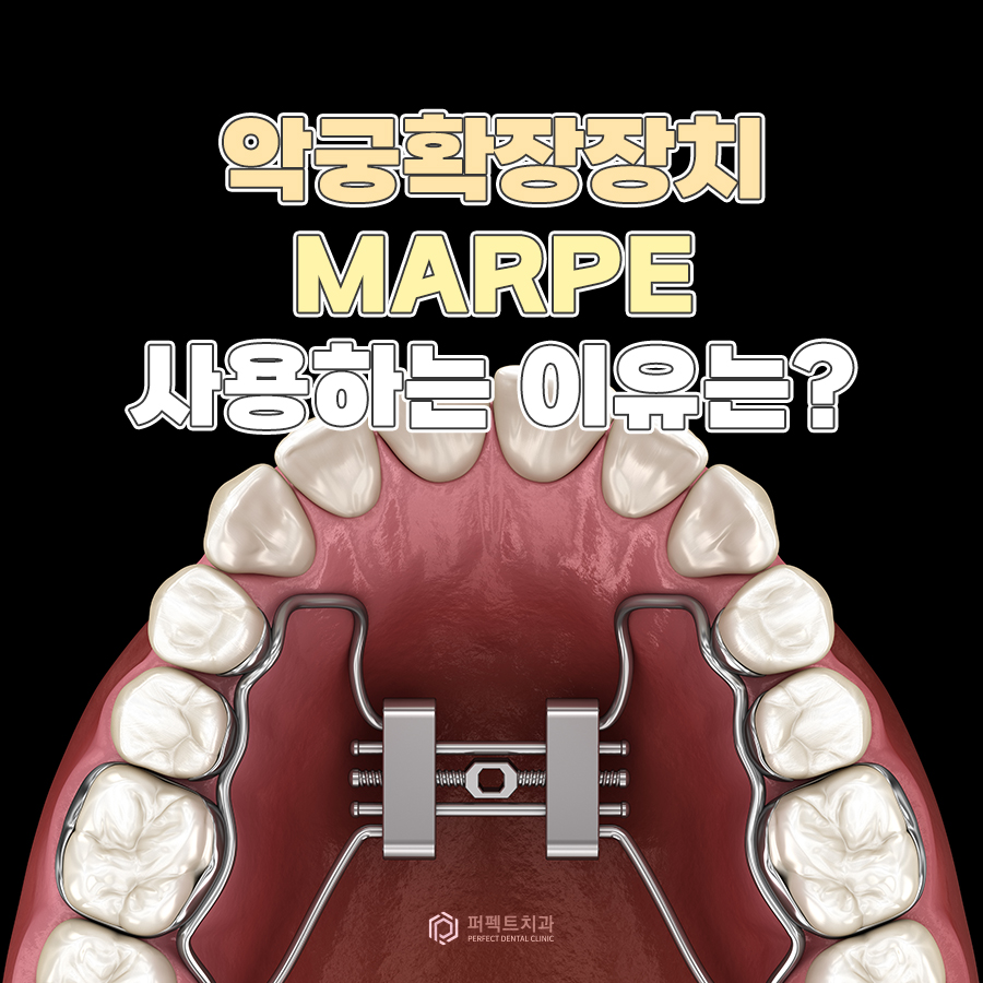악궁확장장치 MARPE, 사용하는 이유는? 관련 이미지 1