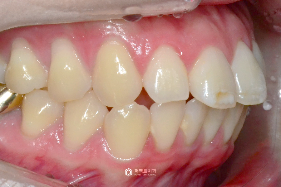 라미네이트를 하면 안되는 경우도 있다? 관련 이미지 2