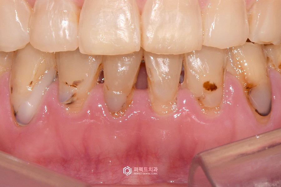 벌어진 앞니, 레진으로 치료 가능? 관련 이미지 3