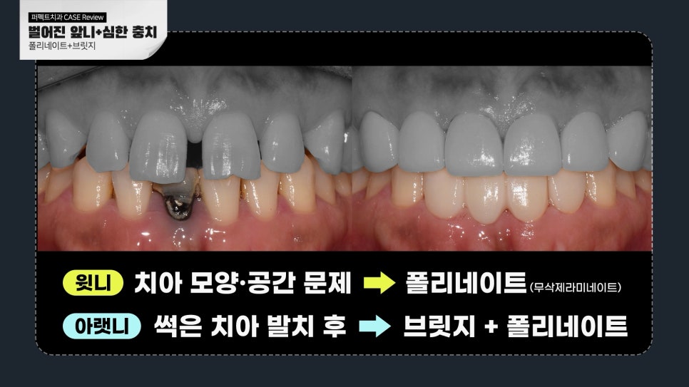 충치+벌어진앞니 라미네이트 case 관련 이미지 4