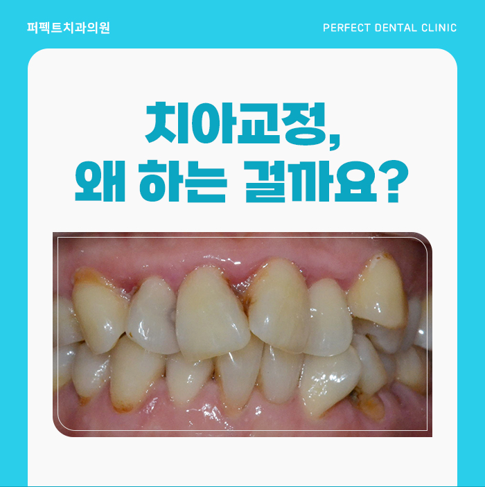 치아교정, 치료 시 참고사항은? 관련 이미지 4