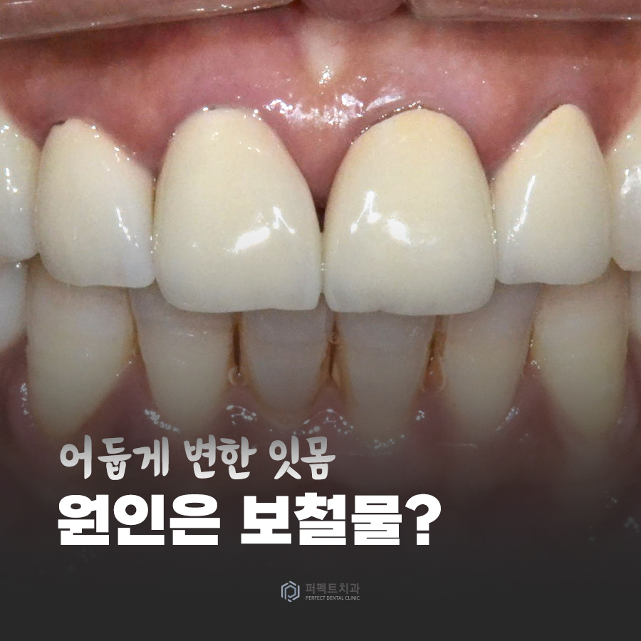 어둡게 변한 검은 잇몸, 원인은 치료 받았던 보철물? 관련 이미지 1