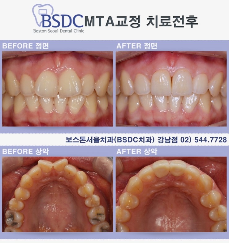 mta교정 소재현원장이 알려주는 앞니부분교정이야기 관련 이미지 3