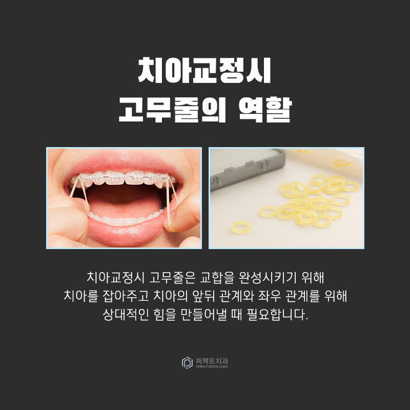 치아교정시 고무줄을 자주 바꿔줘야 하나요? 관련 이미지 2