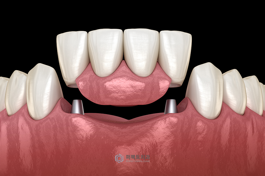 임플란트 후 임시치아, 임시틀니② 관련 이미지 2